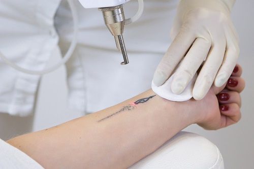 Cómo borrar un tatuaje que no te gusta